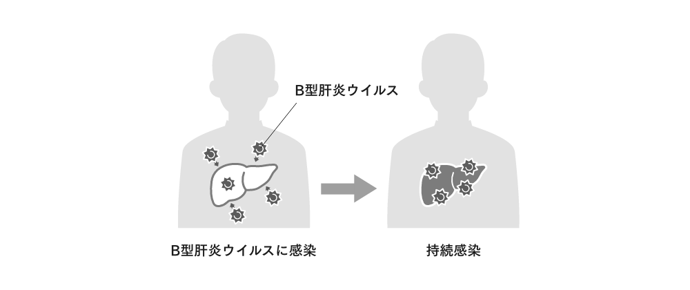 B型肝炎が発症するしくみ